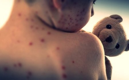 Japan reports more than 400 measles cases since January