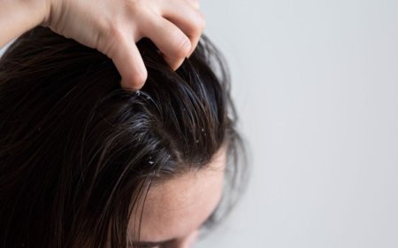 Effective Ways to Tackle Stubborn Scalp Flakes for Good