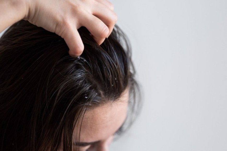 Effective Ways to Tackle Stubborn Scalp Flakes for Good