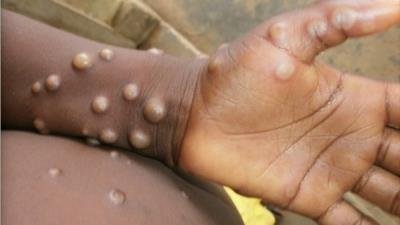 Monkeypox spreads to more than 20 countries: WHO