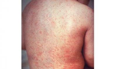 Measles outbreak in UP village, three children die