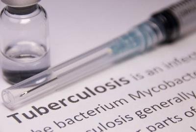 Many cases of TB can appear without symptoms like cough: Experts