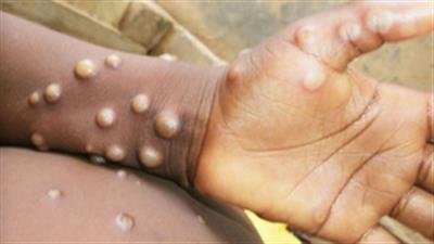 Africa CDC calls for urgent action against concerning spread of mpox