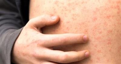US measles cases continue to rise
