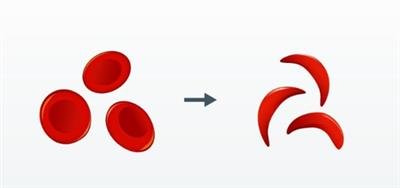 Sickle Cell elimination mission tackling genetic disorder to ensure equity, dignity: PMO