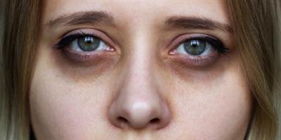 Understanding Dark Circles: More Than Just a Sign of Tiredness 